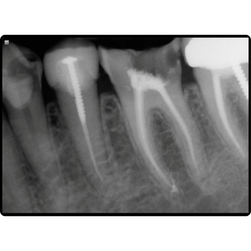 Root Canal Final
