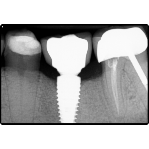 dental implant